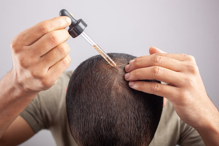 Topical Finasteride for Hair Loss Does It Work  DrFormulas
